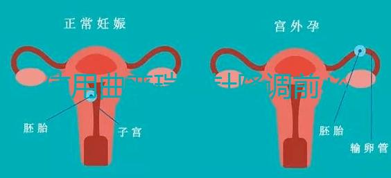 使用曲普瑞林針降調(diào)前必看:3大作用對比5大副作用