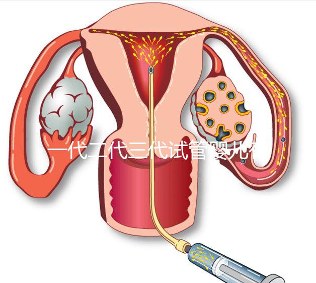 一代二代三代試管嬰兒有什么區別？